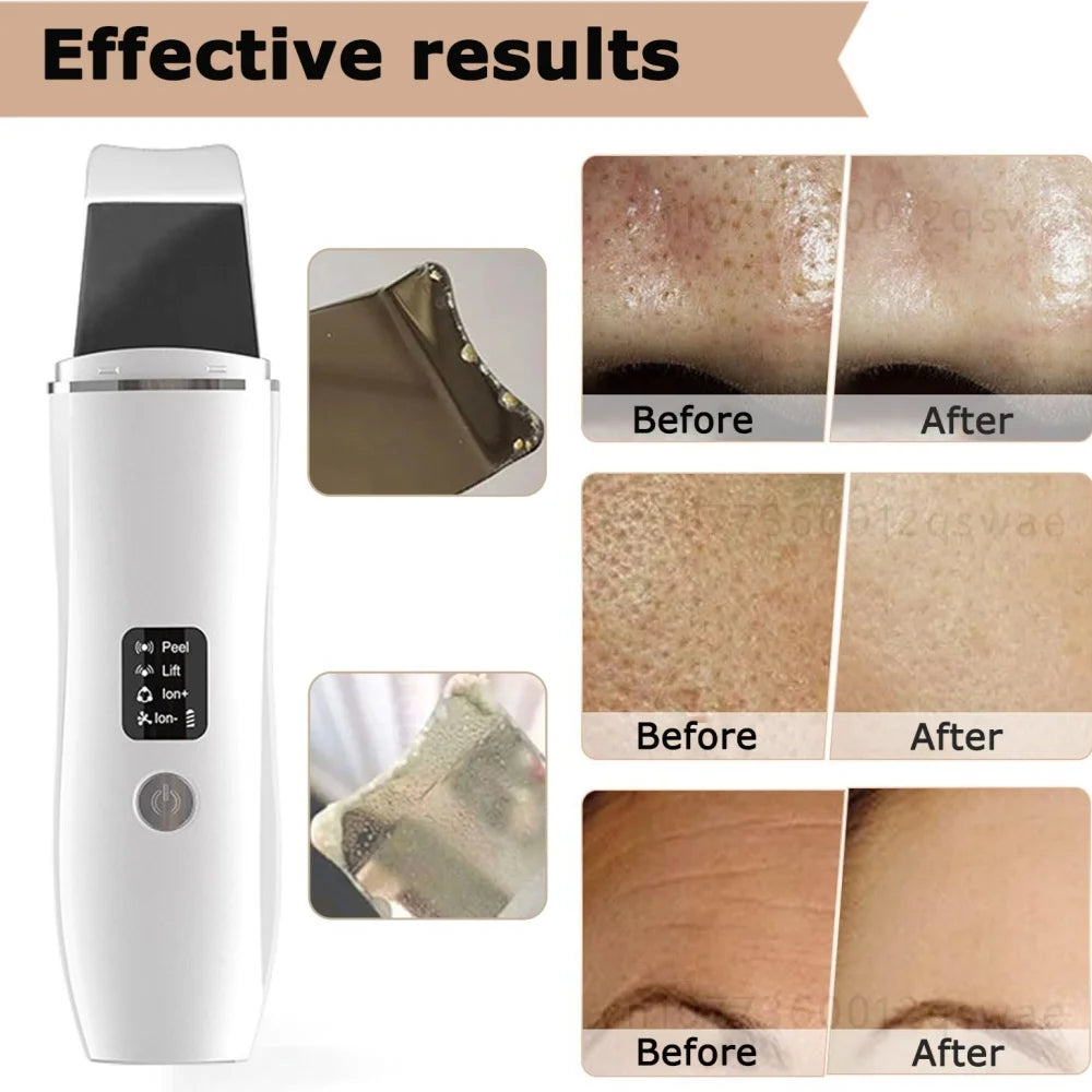 Ultrasonic Blackhead Remover